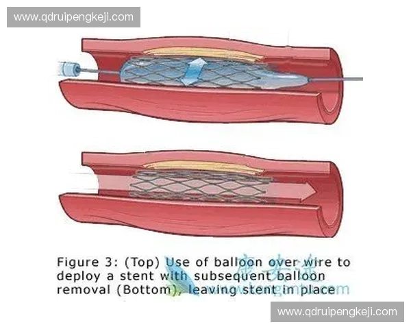 运动方向支架设计与应用研究创新发展趋势及挑战分析 运动方向支架设计与应用研究创新发展趋势及挑战分析
